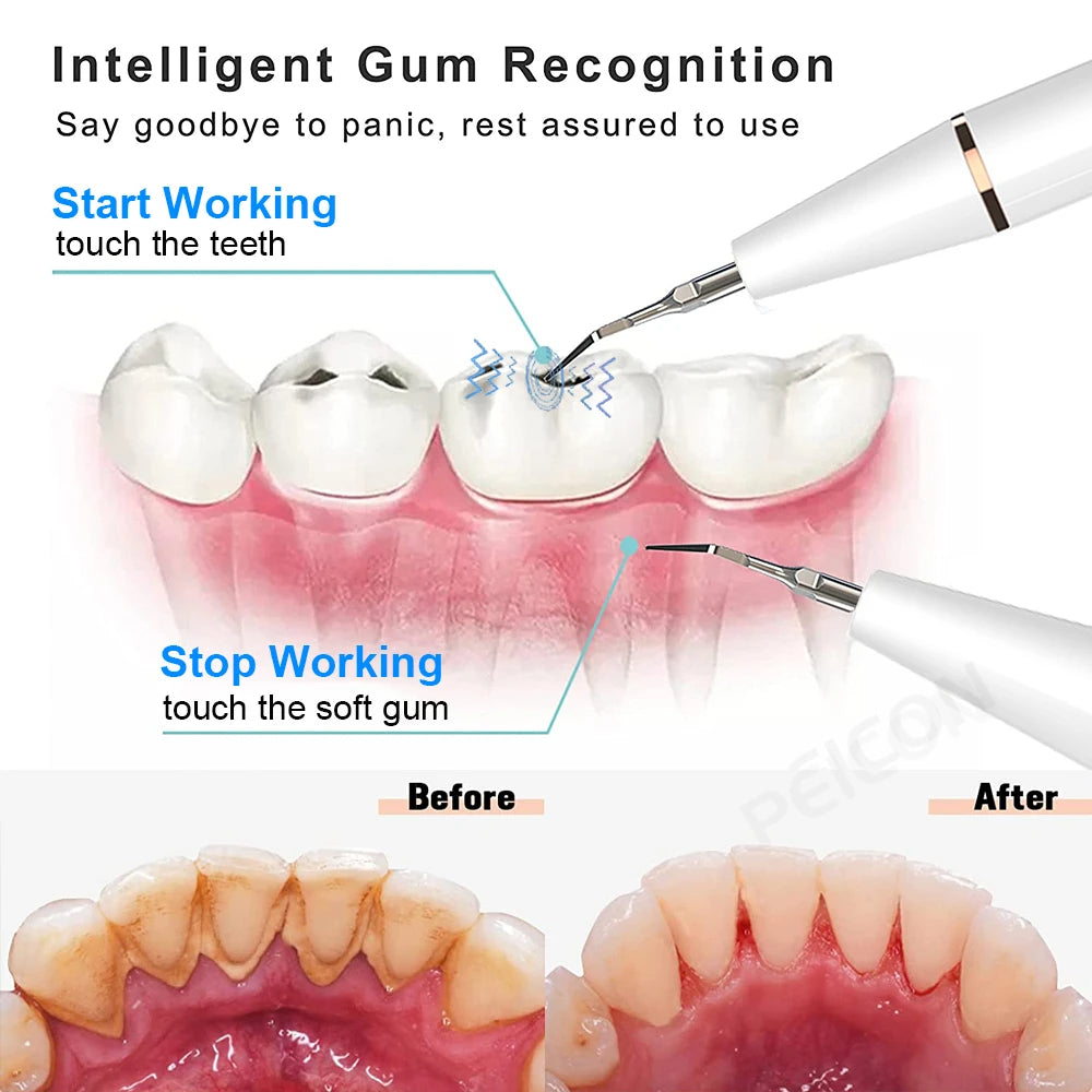 ULTRASONIC DENTAL TEETH PLAQUE REMOVER & CLEANER