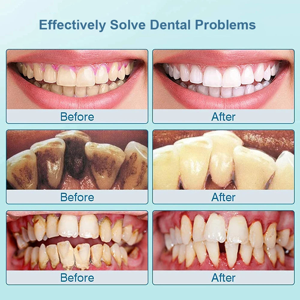 ULTRASONIC DENTAL TEETH PLAQUE REMOVER & CLEANER